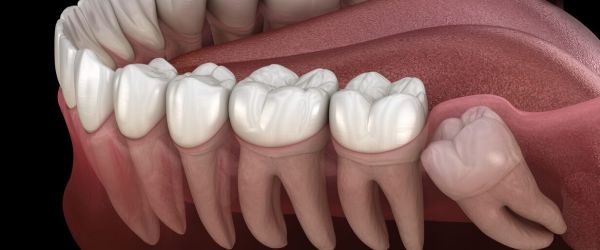 Ways to Reduce Wisdom Tooth Swelling